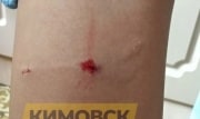 В Кимовске 14-летнюю девочку покусала собака